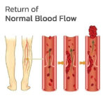 Varicose Veins Patches - Image 3