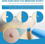 Auto Skin Tag Remover Kit - Image 4