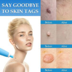 Auto Skin Tag Remover Kit - Image 6